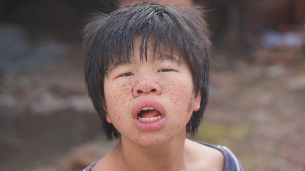 花季少女身患罕见怪病样貌奇异不敢出门甚至被人叫作怪物