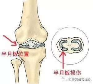 膝盖半月板损伤，多久可以恢复？
