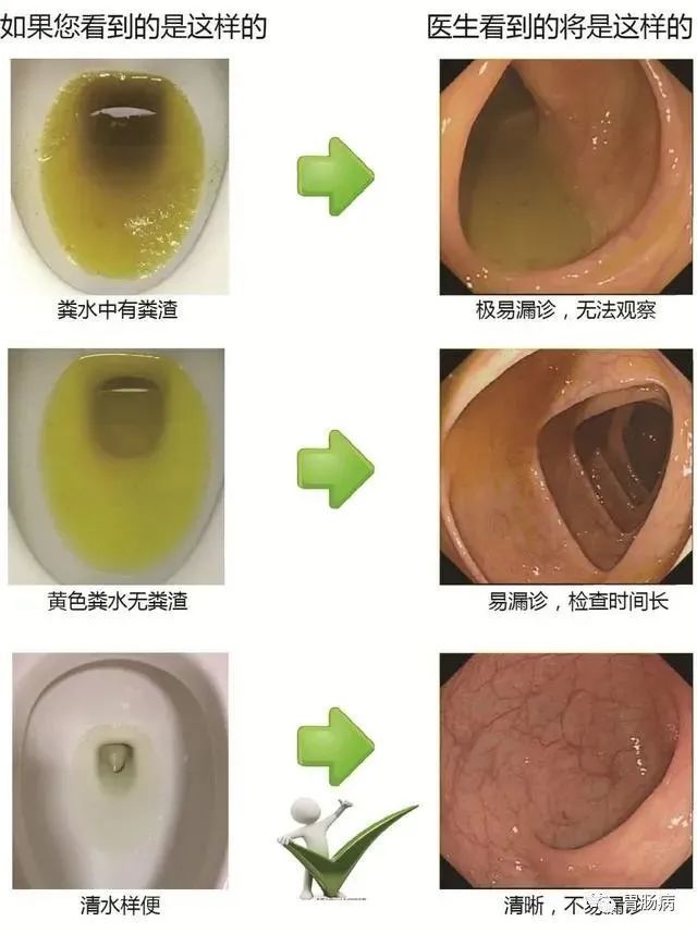 肠镜准备怎样才算干净图片