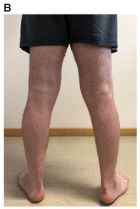 图4:(a和b)肱骨肌和腓骨肌萎缩,肘部肌腱挛缩,双臂伸展完全受限