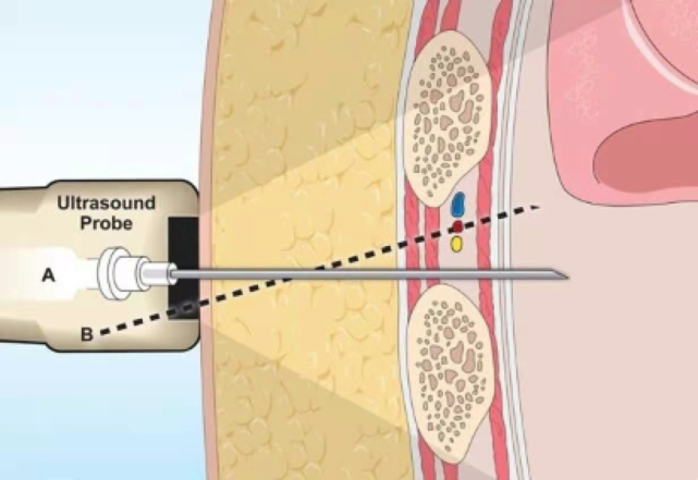 查出肺结节医生让穿刺到底穿还是不穿医生说没有穿刺一半肺癌确诊不了