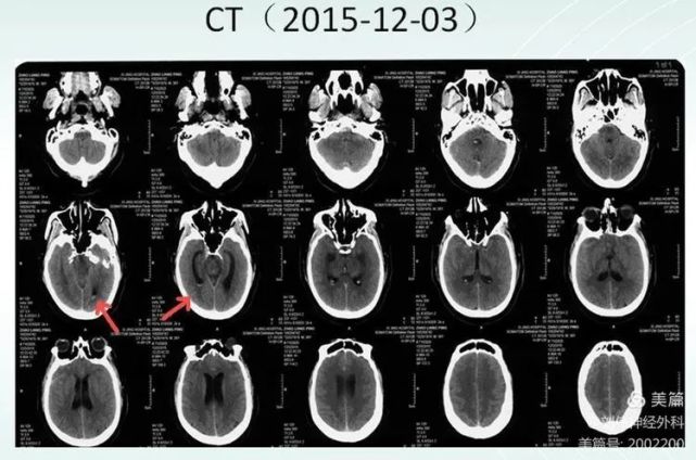 ct脑室出血对于一些蛛网膜下腔出血,造