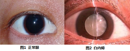 白内障过去,医疗水平不高,同时大众也普遍缺乏眼保健意识,让这些致盲