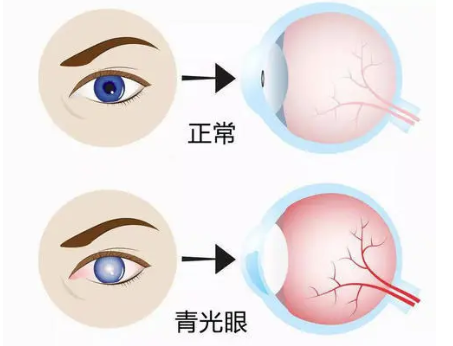 青光眼是什么？关灯后玩手机会得青光眼吗？(图1)