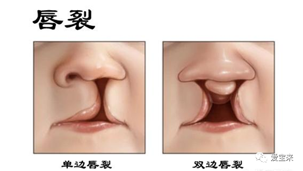 对于兔唇你了解多少?_腾讯新闻