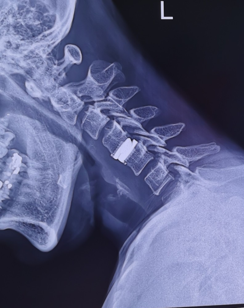 颈椎病人工间盘植入