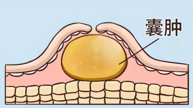 什么是纳氏囊肿宫颈纳氏囊肿会变癌吗让医生告诉你