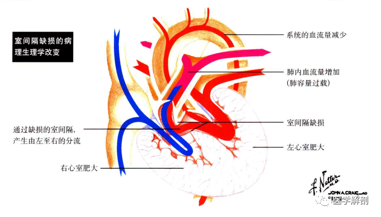 奈特解剖图谱胎儿的血液循环及先天性心脏缺陷