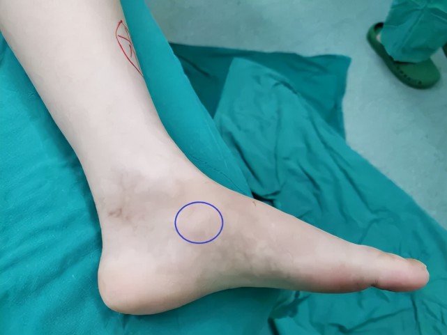 孩子运动后足内侧疼痛足副舟骨问题家长们要警惕