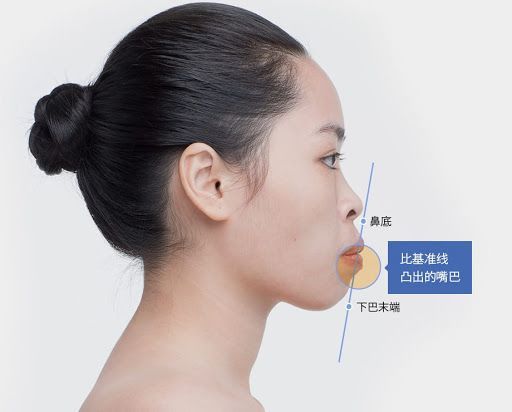 e线刚好接触或在其后方;而嘴巴超过这条线或者根本找不到颏前点在哪里