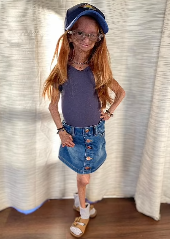 拥有百万粉丝的早衰症少女去世,但她的乐观感动过无数人呀!