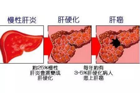 肝硬化有效的治療方式,但供體短缺,手術費用昂貴以及術後併發症等限制