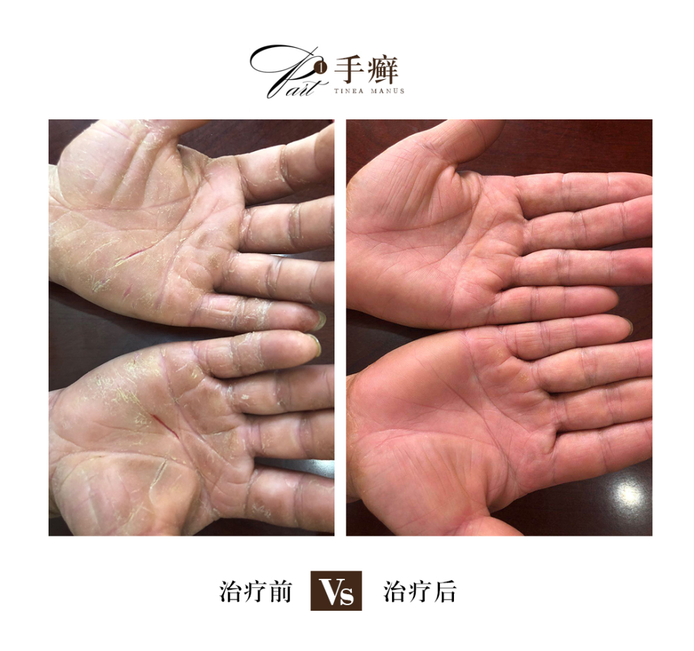 手足癣的症状与特征有哪些?_腾讯新闻