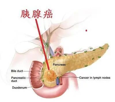 胰腺癌从确诊到死亡,只有5个月,医生提醒4个症状别再拖