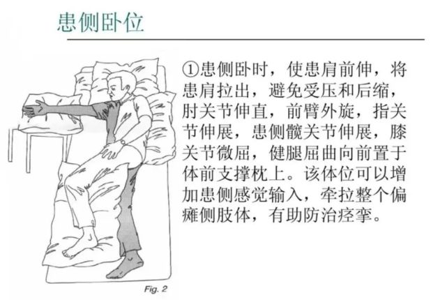 肩痛,肩手综合征,骨盆后倾,髋关节外展,外旋以及早期诱发分离运动等均