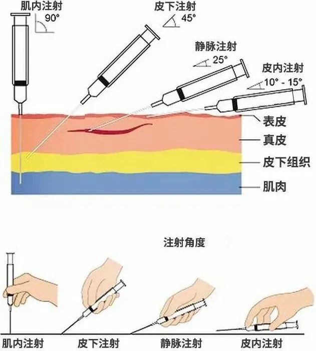 5.扎针的方式也有讲究!