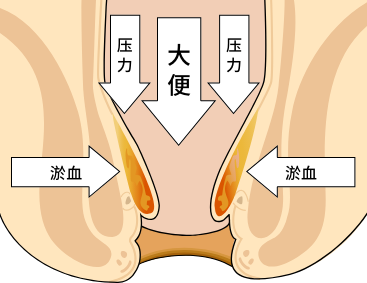 小夥痔瘡便血進了icu得了痔瘡怎麼辦