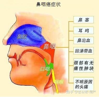 鼻咽癌,顧名思義,就是發生在鼻咽部的癌症,具體來說是指發生於咽隱窩