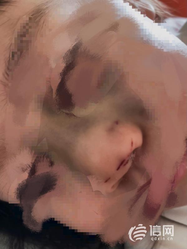 孩子受伤(来源:家长)幼儿鼻骨骨折后3个小时才告知家长刘女士的孩子