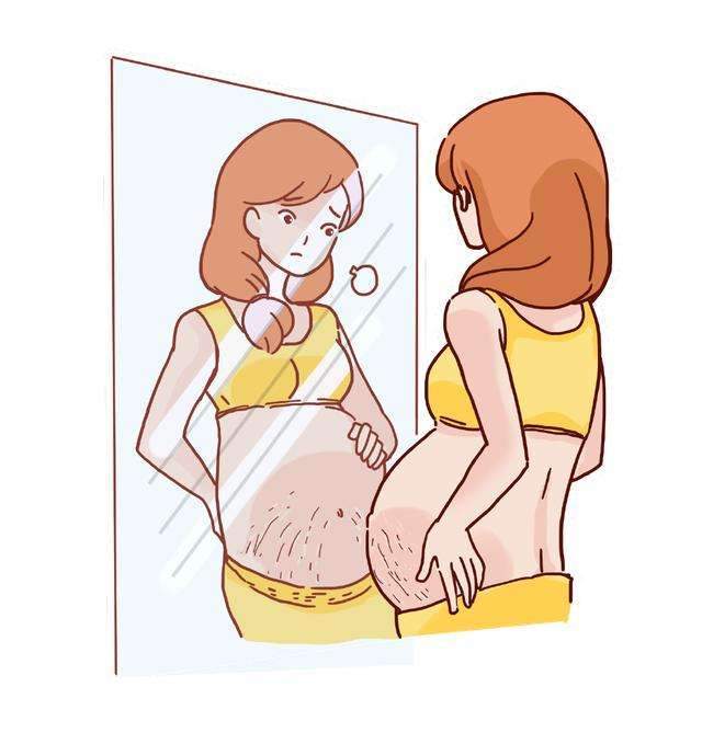 妊娠纹严重影响了妇女产后的体态和身心健康.