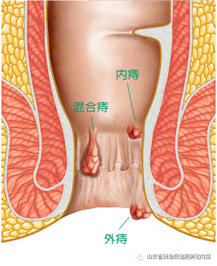 内痔什么情况下需要治疗6个问题带你搞清痔疮