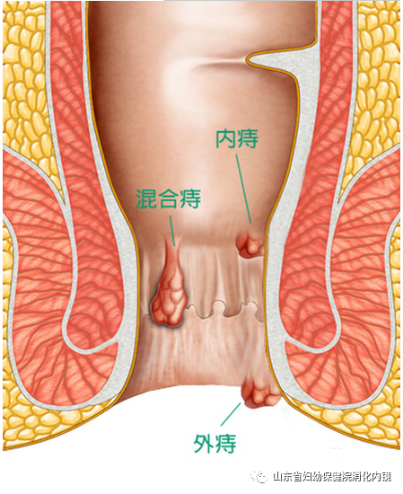 痔疮种类图片