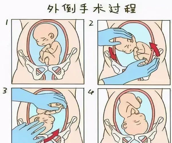 厲害了產科臀位外倒轉術幫助臀位寶寶華麗轉身