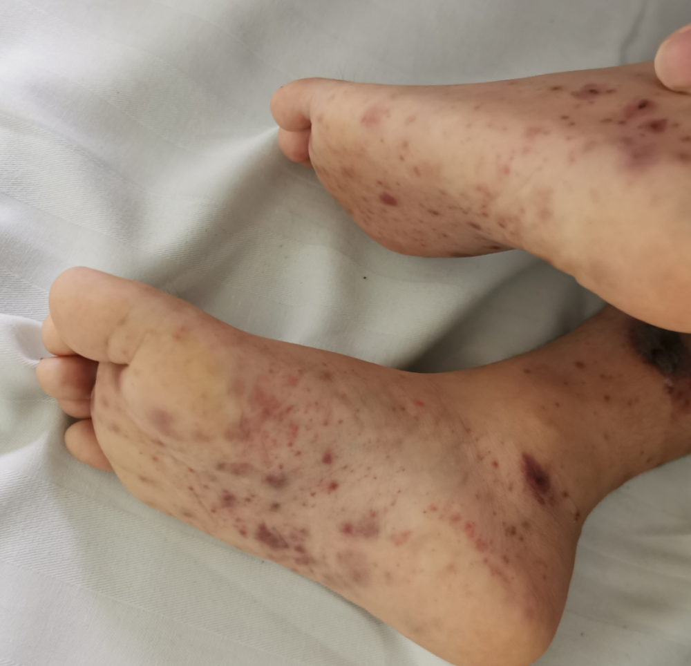 男孩全身淤青学校险成背锅侠检查后才知是这种病