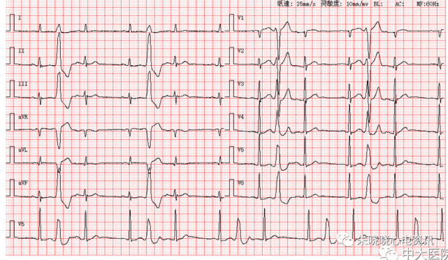 每日读图 || 第1624期 室早