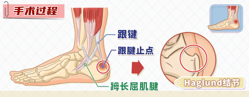 跟腱运动的支点称为haglund结节,位于跟骨后上方,距离跟腱止点(跟腱与