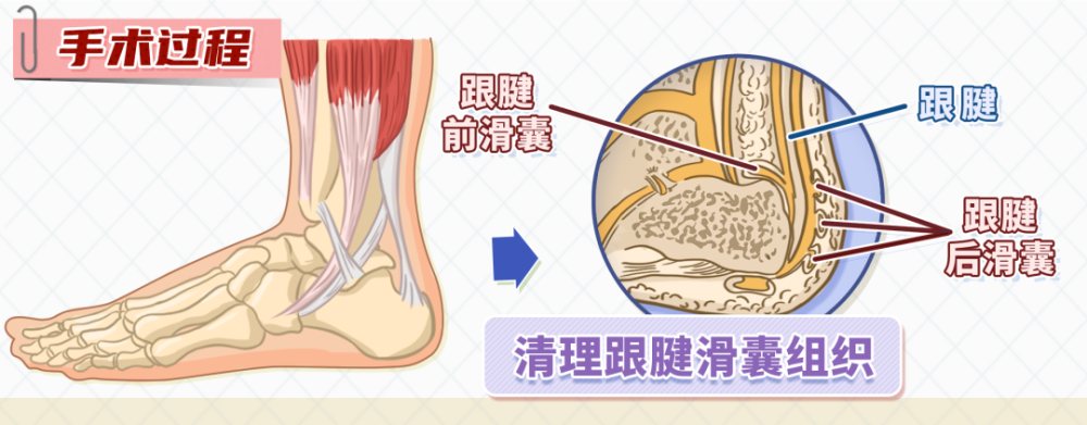 跟腱炎反反覆覆藥物手術封閉流行新療法該如何選擇