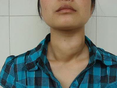 患上甲状腺结节怎么办建议日常坚持3少吃甲功恢复健康如初