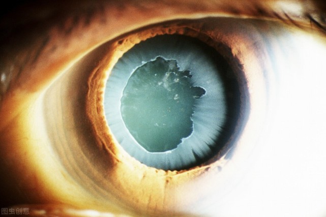 治疗青光眼有哪些治疗?医生:不同的病因,适合不同的治疗方式