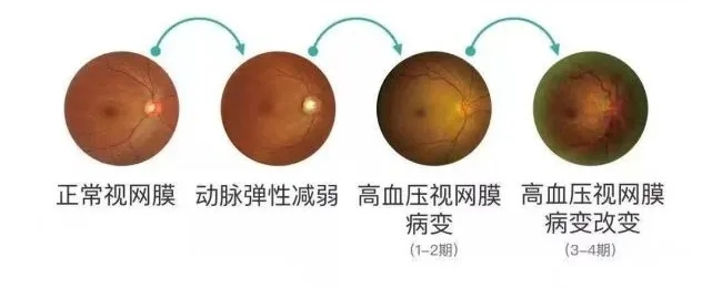高血压视网膜病变眼底检查不仅是检查视网膜,脉络膜和视神经疾病的