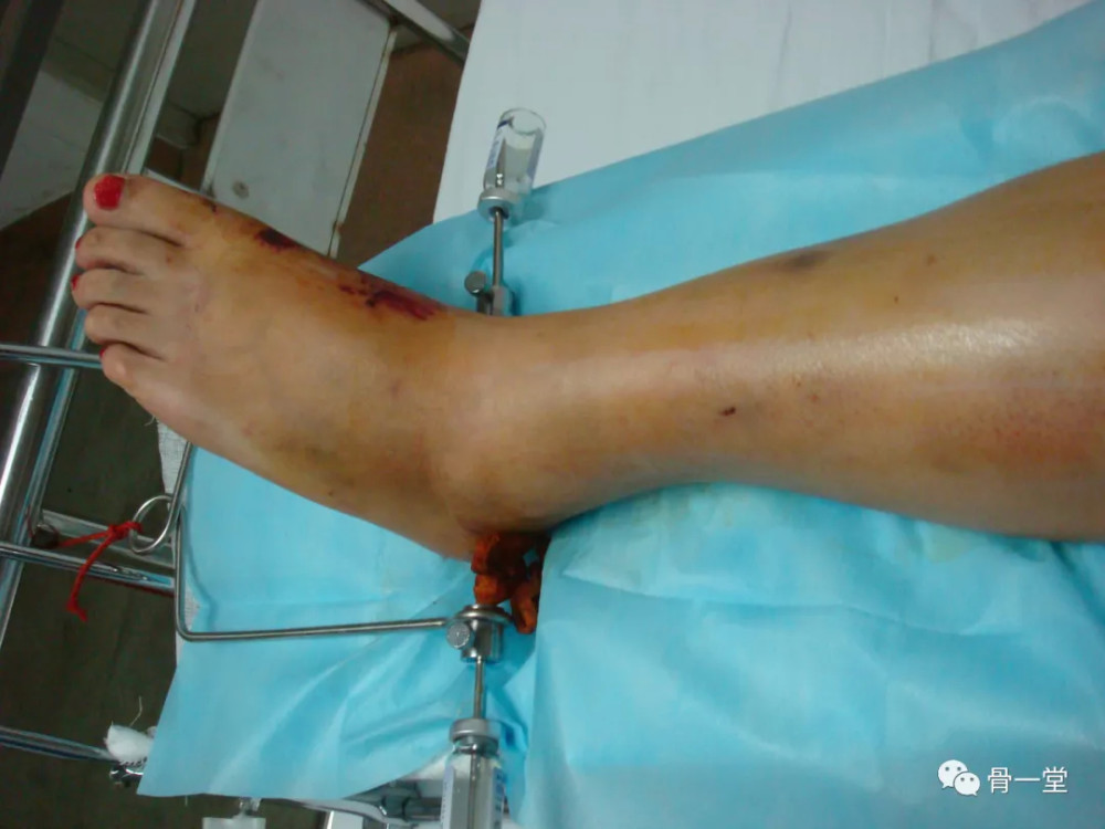 骨牵引健康宣教