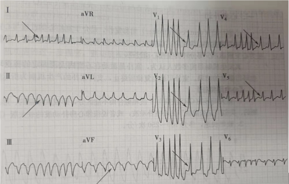 室速室颤预激伴房颤常见高危心律失常如何识别和处理
