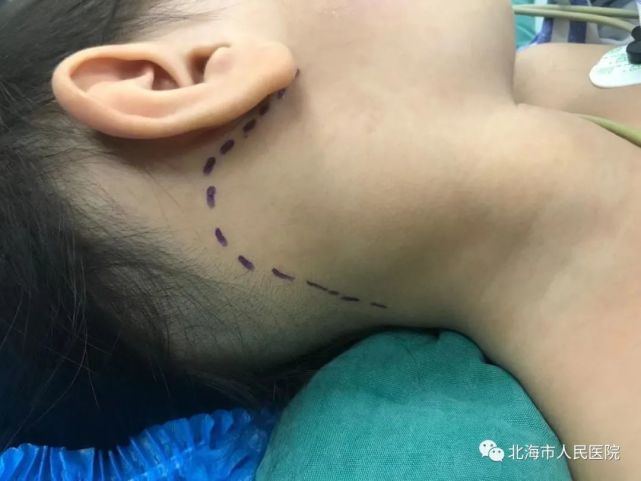 北海4歲女孩脖子長了雞蛋大般腫物,一查竟是先天性鰓裂囊腫!