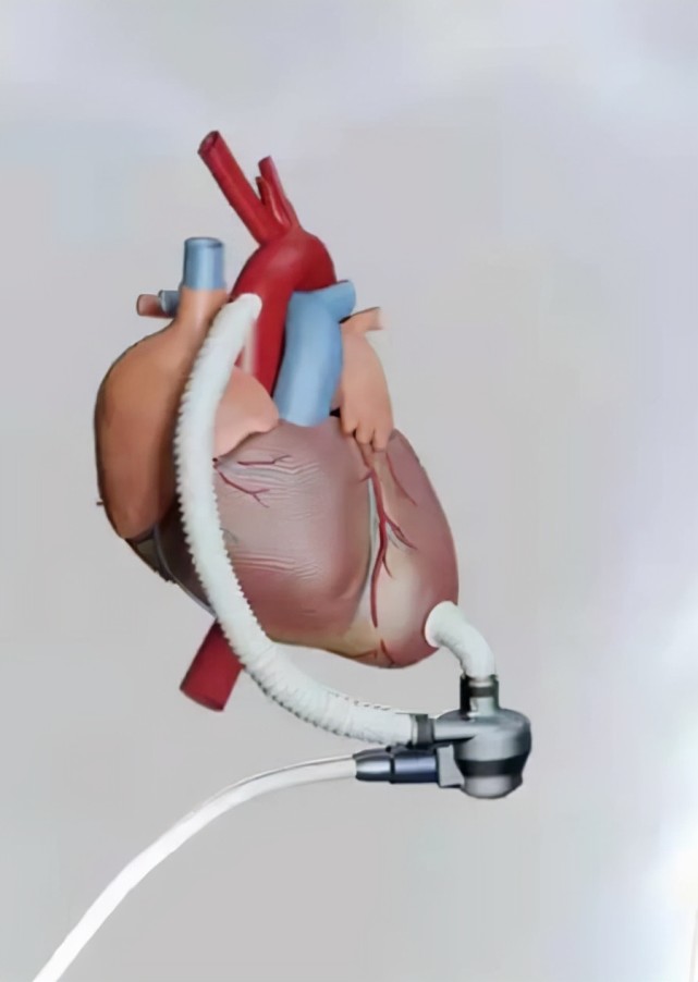 46岁男子植入人工心脏,随身携带小挎包每天为"心"充电