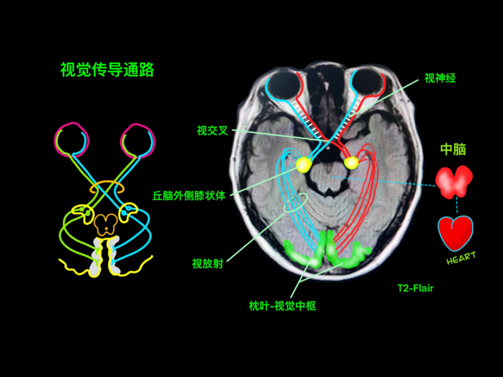 中腦,大腦腳mr 冠狀位顳葉解剖正常垂體大小鞍區的精細解剖