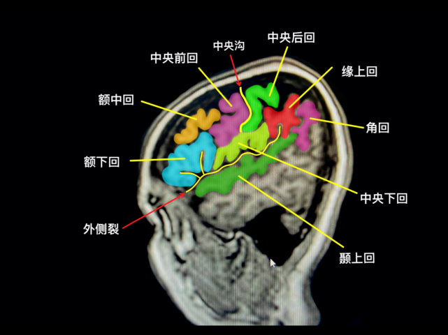 沟,舌叶"鱼嘴造型"鞍区的精细解剖正常垂体大小mr 冠状位颞叶解剖中脑