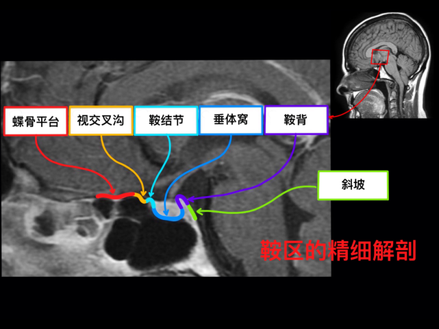 繼續更新顱腦mr閱片手繪版進階版