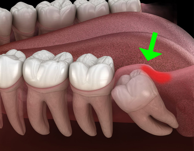 女子拔智齿牙医生拉硬拽摇晃1小时看着太恐怖