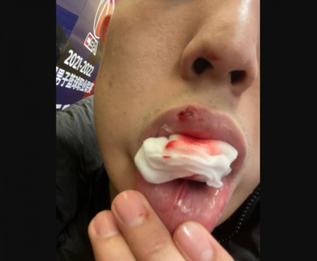 嘴被打裂血流不止没报复对手用胜利说话大韩该向此人学习