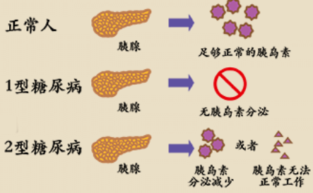 其實不然,糖尿病的發病機制其實有很多,主要可以總結為胰島素分泌不足