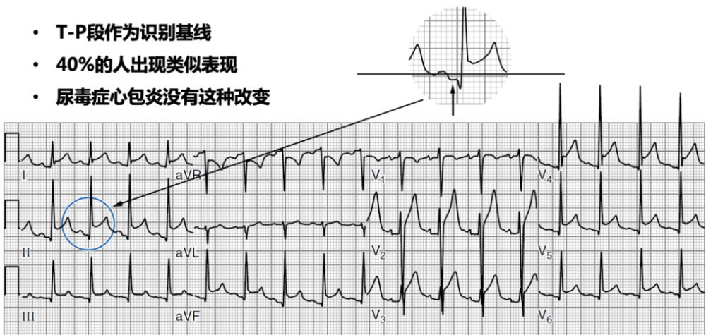 spodick征:一种急性心包炎的特征性心电图_腾讯新闻