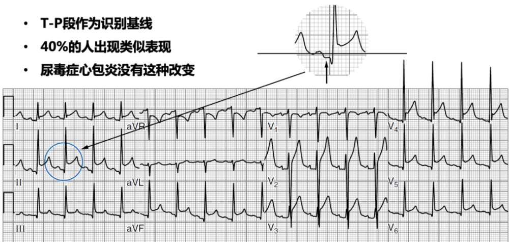 spodick徵一種急性心包炎的特徵性心電圖