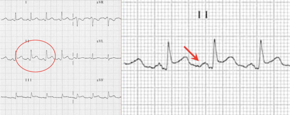 spodick征:一种急性心包炎的特征性心电图_腾讯新闻