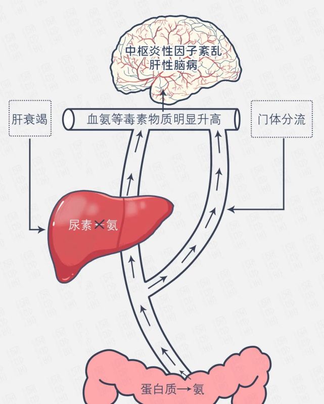 (3)氨中毒学说现被广泛接受[8]图源:医会宝编辑部,参考文献[3(2)he的