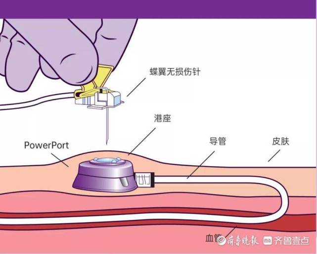 输液港固定图片图片