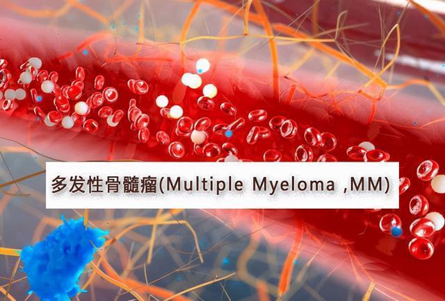 多发性骨髓瘤创新药实现医保报销给患者带来治愈希望